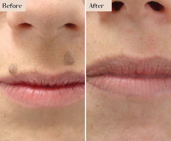 mole removal before after